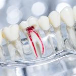 Gyulladt fogbél és gyökércsatornák szemléltető anatómiai modellje a gyökérkezelés folyamatához – Next Dent Kecskemét
